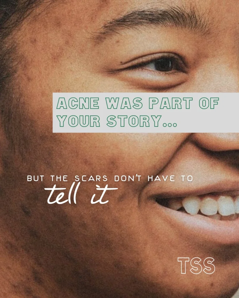 Acne scarring and active breakouts require a thoughtful, strategic approach